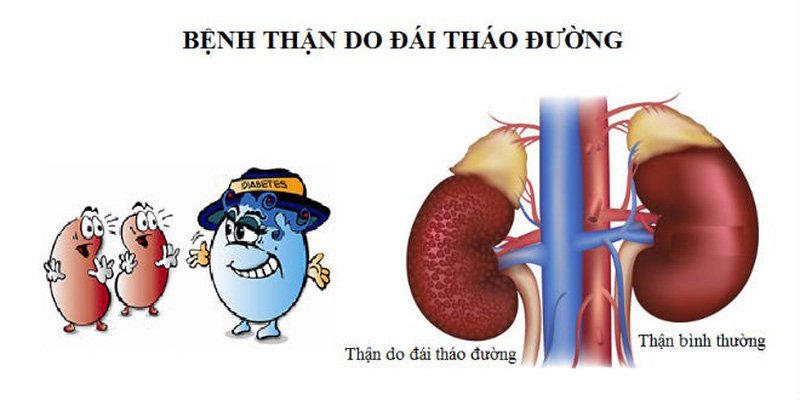 Bệnh thận là biến chứng phổ biến do đái tháo đường